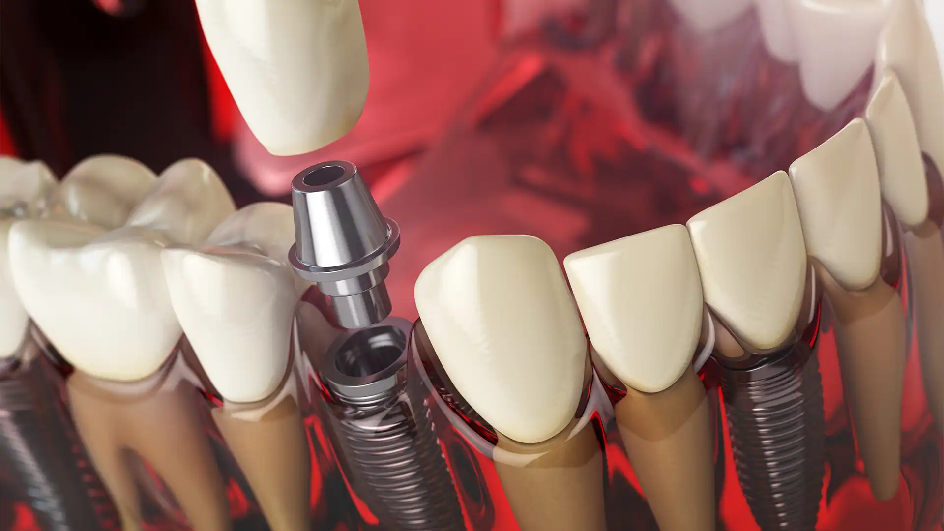 найкращі стоматологічні клініки в Туреччині для імплантації